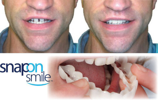 Dientes Snap-On Perfectos